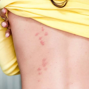 Bedbugs Control 